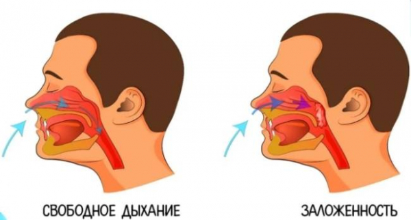 Как избавиться от заложенности носа в домашних усл