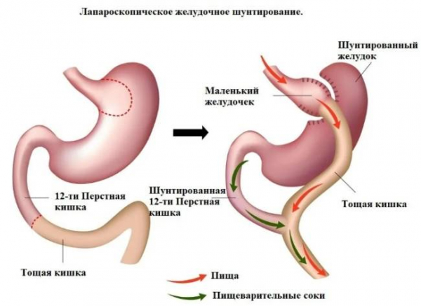 Преимущества и недостатки операции по шунтированию желудка