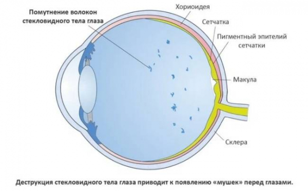 Мушки в глазах: симптомы, причины, лечение